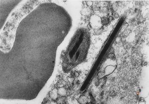 bone marrow - crystalloid inclusions Charcot-Leyden crystals formation bone marrow - crystalloid inclusions Charcot-Leyden crystals formation